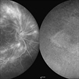 Cystoid Macular Edema (CME) Cystoid Macular Edema (CME)